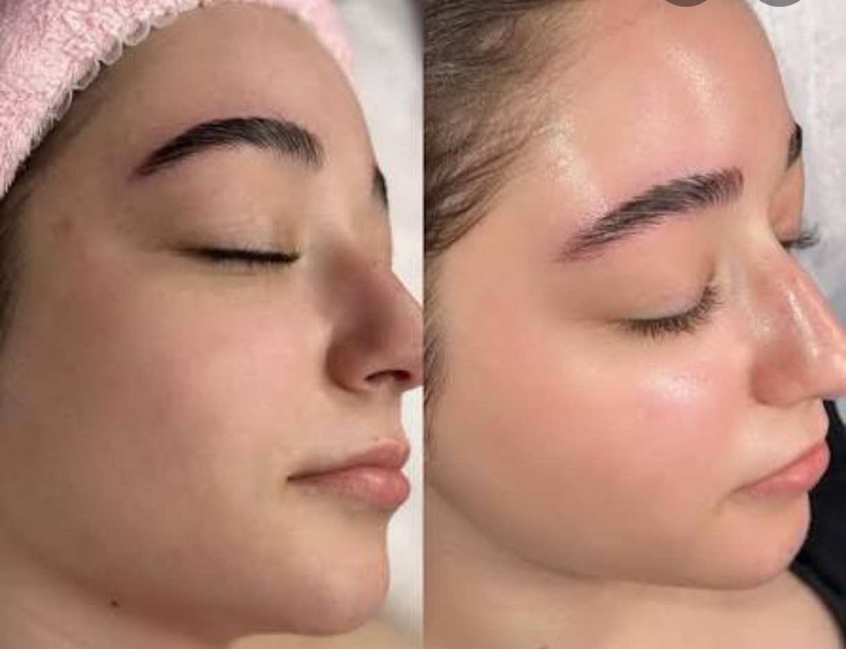 Hydraglo Facial